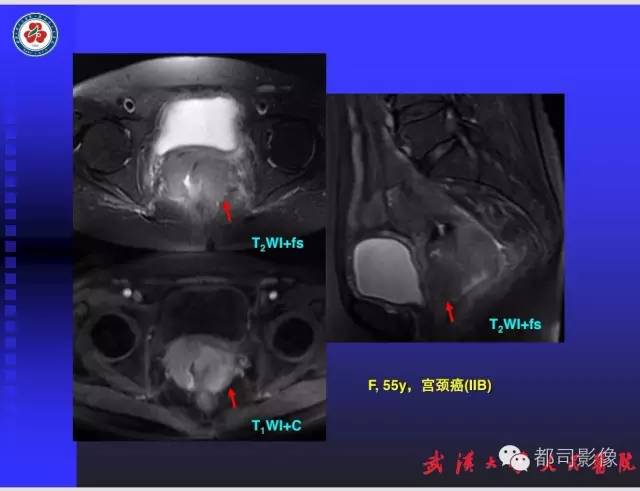 【PPT】妇科肿瘤临床MRI