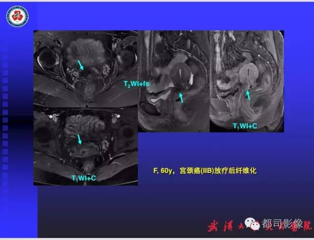 【PPT】妇科肿瘤临床MRI