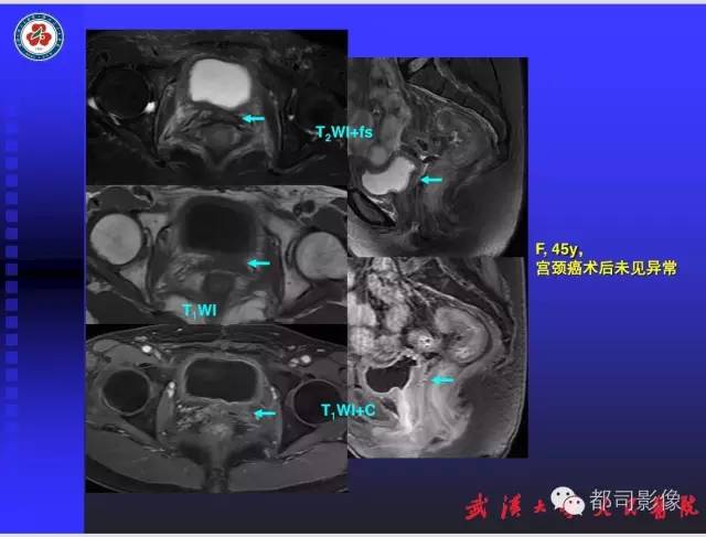 【PPT】妇科肿瘤临床MRI