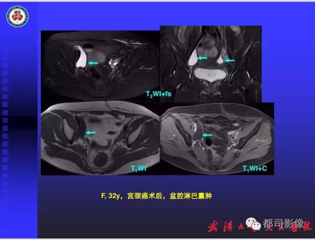 【PPT】妇科肿瘤临床MRI