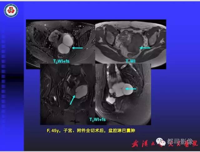 【PPT】妇科肿瘤临床MRI