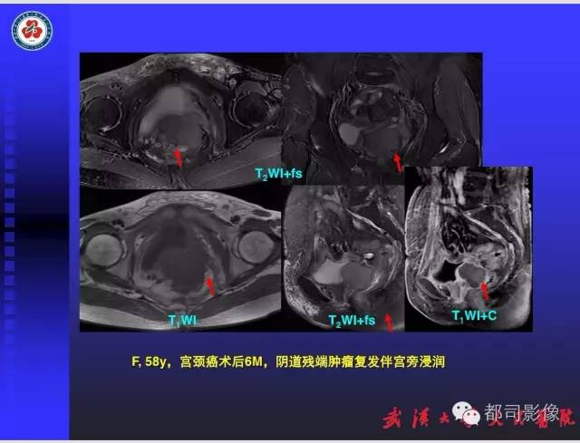 【PPT】妇科肿瘤临床MRI