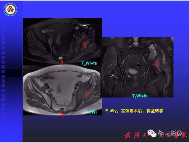 【PPT】妇科肿瘤临床MRI