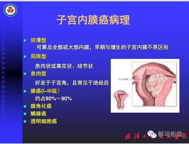 【PPT】妇科肿瘤临床MRI