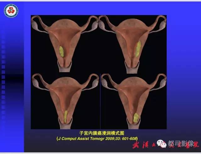 【PPT】妇科肿瘤临床MRI
