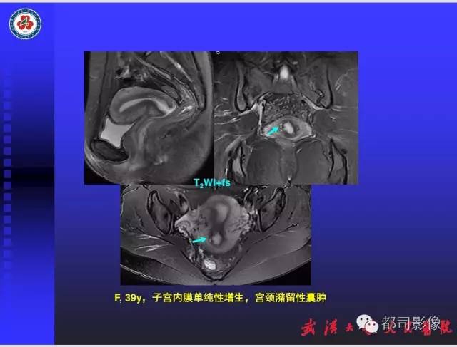 【PPT】妇科肿瘤临床MRI
