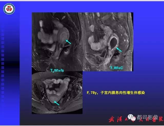 【PPT】妇科肿瘤临床MRI