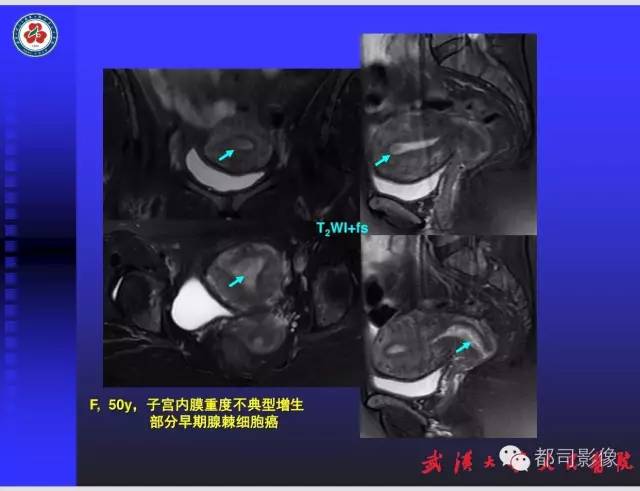 【PPT】妇科肿瘤临床MRI