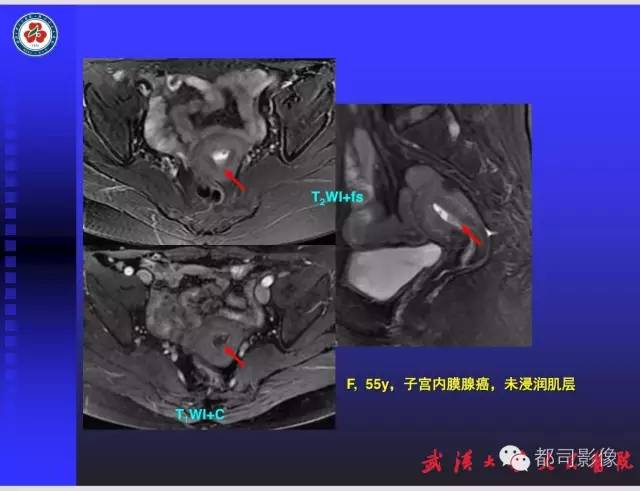 【PPT】妇科肿瘤临床MRI