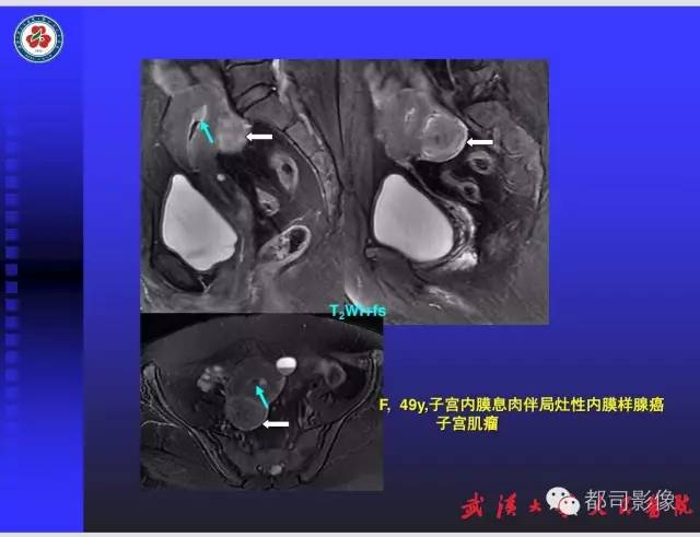 【PPT】妇科肿瘤临床MRI