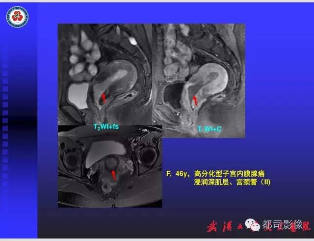 【PPT】妇科肿瘤临床MRI