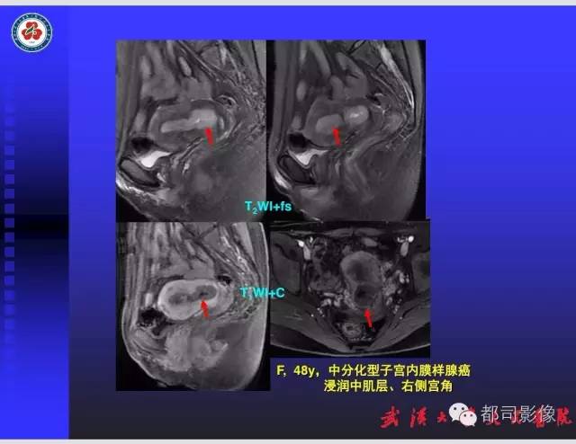 【PPT】妇科肿瘤临床MRI