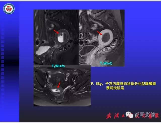 【PPT】妇科肿瘤临床MRI