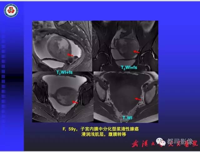 【PPT】妇科肿瘤临床MRI