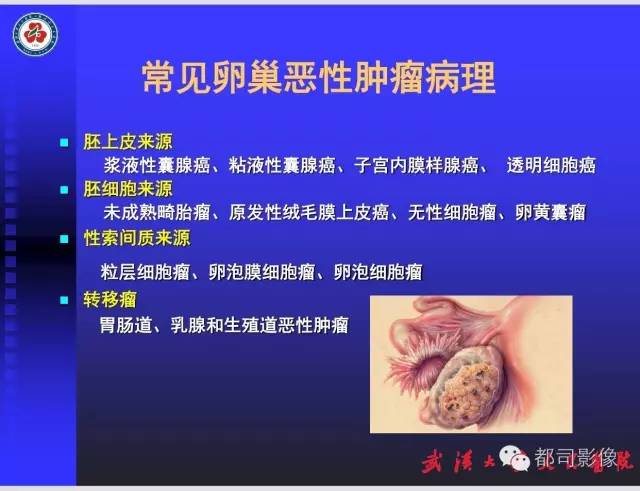 【PPT】妇科肿瘤临床MRI