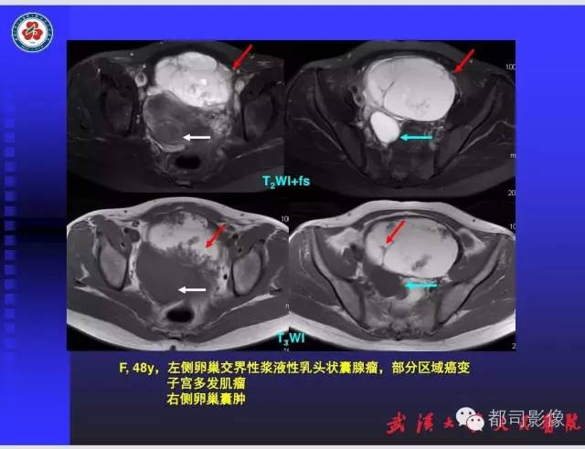 【PPT】妇科肿瘤临床MRI