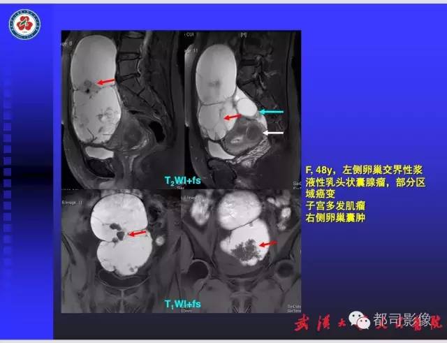 【PPT】妇科肿瘤临床MRI