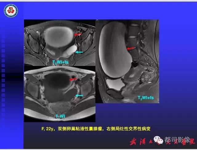 【PPT】妇科肿瘤临床MRI