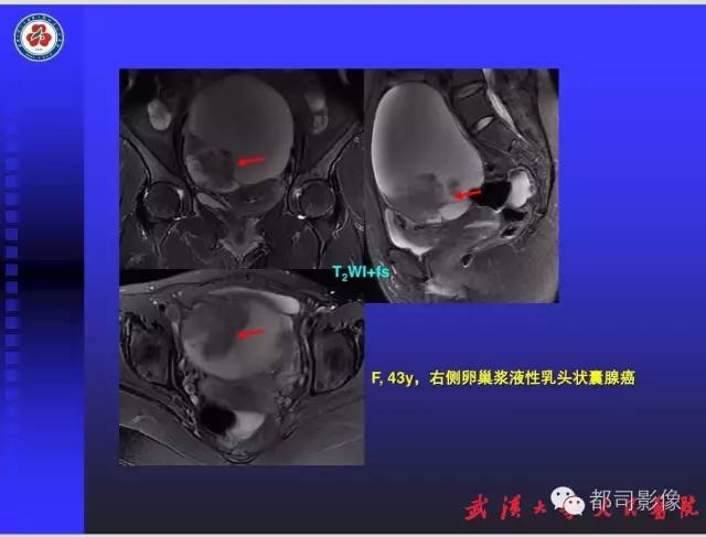 【PPT】妇科肿瘤临床MRI