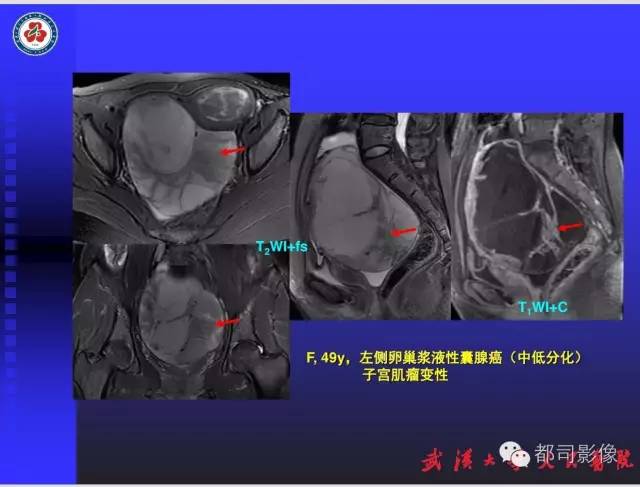 【PPT】妇科肿瘤临床MRI