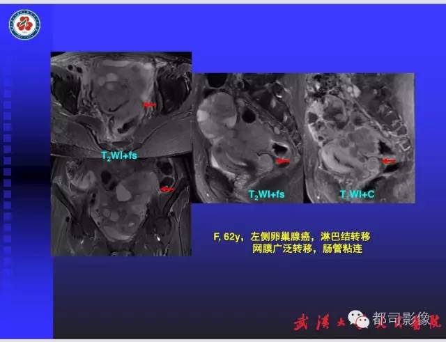 【PPT】妇科肿瘤临床MRI