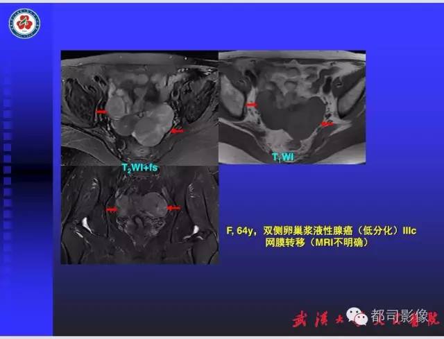 【PPT】妇科肿瘤临床MRI