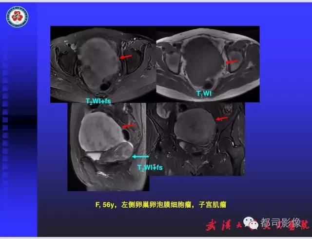 【PPT】妇科肿瘤临床MRI