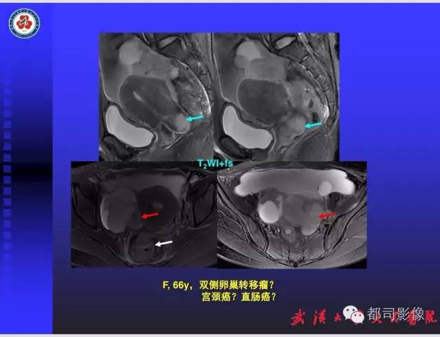 【PPT】妇科肿瘤临床MRI