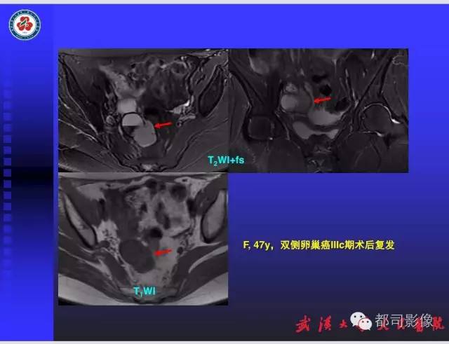 【PPT】妇科肿瘤临床MRI