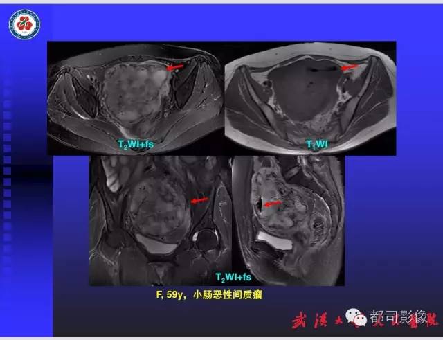 【PPT】妇科肿瘤临床MRI