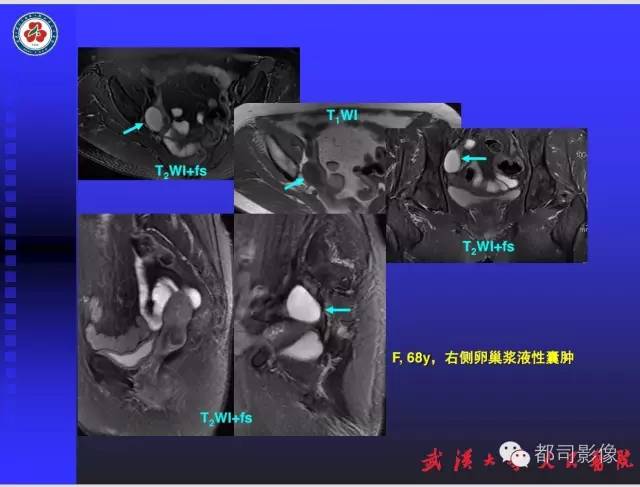 【PPT】妇科肿瘤临床MRI