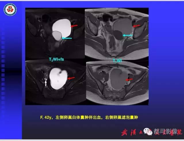 【PPT】妇科肿瘤临床MRI