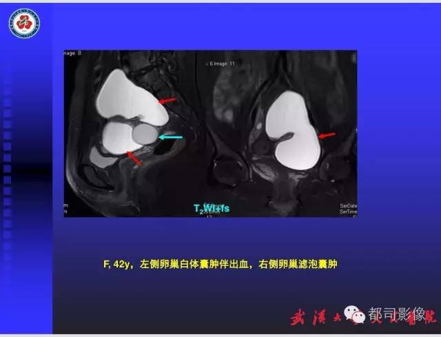 【PPT】妇科肿瘤临床MRI
