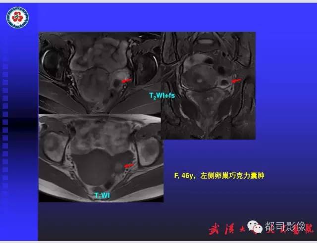【PPT】妇科肿瘤临床MRI