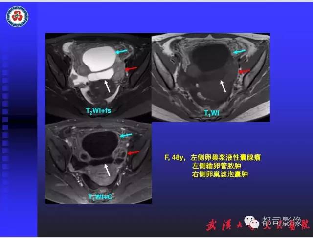 【PPT】妇科肿瘤临床MRI