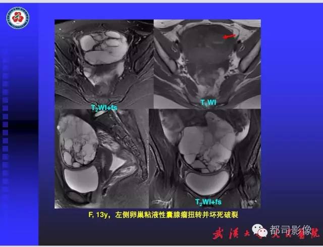【PPT】妇科肿瘤临床MRI