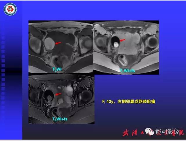 【PPT】妇科肿瘤临床MRI