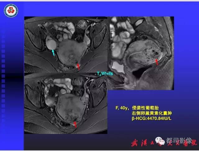【PPT】妇科肿瘤临床MRI