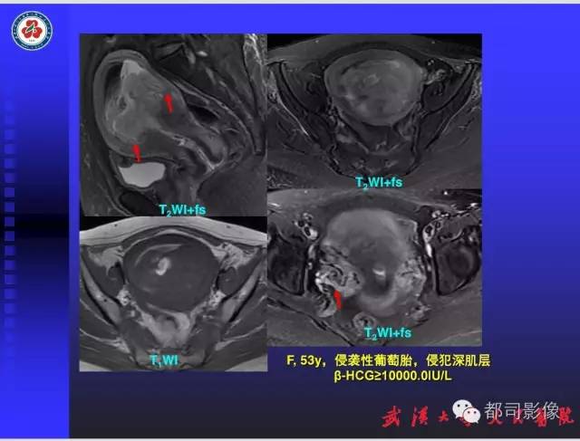 【PPT】妇科肿瘤临床MRI