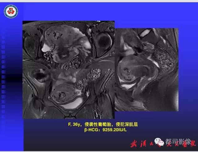 【PPT】妇科肿瘤临床MRI