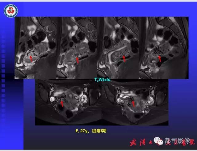 【PPT】妇科肿瘤临床MRI