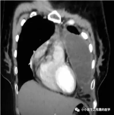 那些CT误诊的“胸水” 那些CT误诊的“胸水”