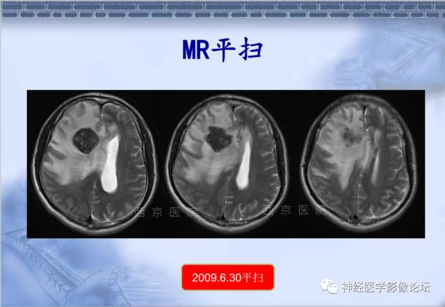 【病例】脑内常见病例的罕见影像表现——肉芽肿性炎1例MR