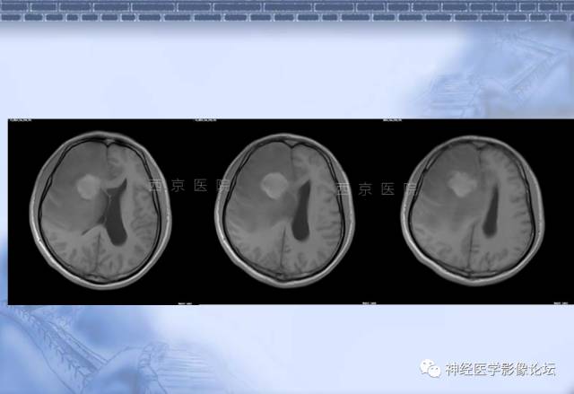 【病例】脑内常见病例的罕见影像表现——肉芽肿性炎1例MR