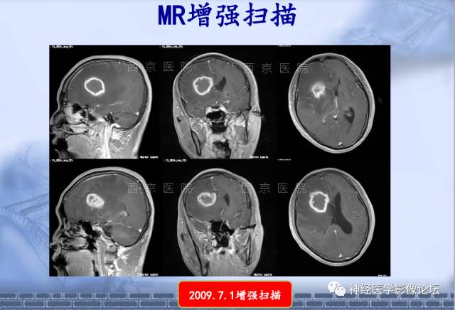 【病例】脑内常见病例的罕见影像表现——肉芽肿性炎1例MR