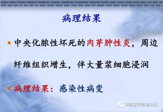 【病例】脑内常见病例的罕见影像表现——肉芽肿性炎1例MR