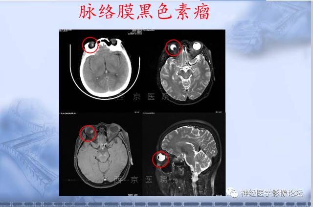 【病例】脑内常见病例的罕见影像表现——肉芽肿性炎1例MR