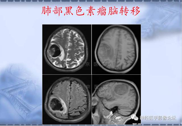 【病例】脑内常见病例的罕见影像表现——肉芽肿性炎1例MR