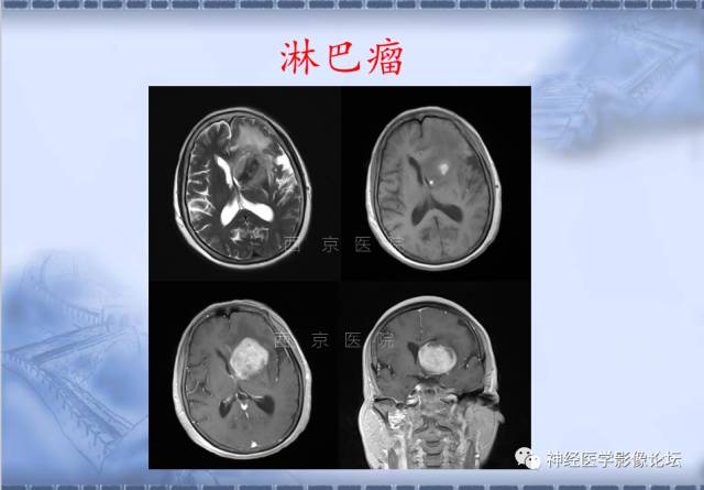 【病例】脑内常见病例的罕见影像表现——肉芽肿性炎1例MR