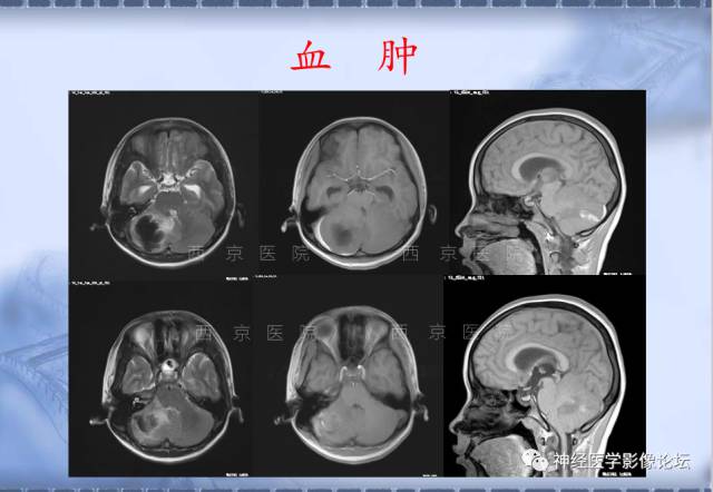 【病例】脑内常见病例的罕见影像表现——肉芽肿性炎1例MR